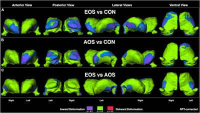 Thalamic Shape Abnormalities Differentially Relate to Cognitive Performance in Early-Onset and Adult-Onset Schizophrenia